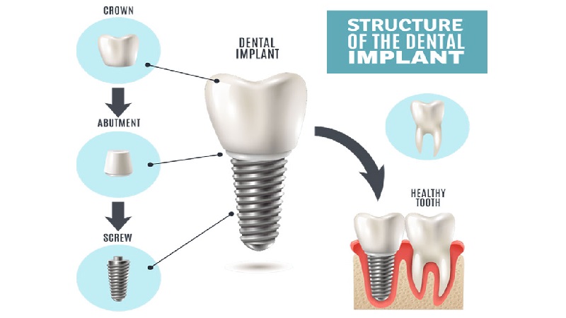 نحوه کاشت ایمپلنت دندان